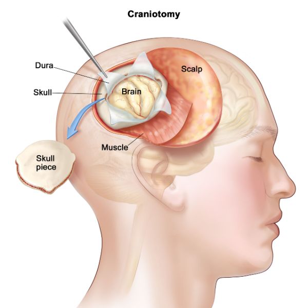 Brain tumor doctor in meerut